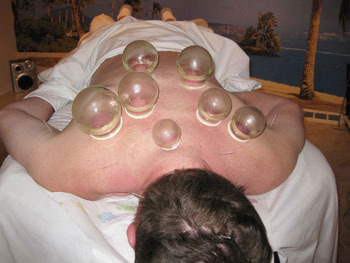 Cupping Therapy